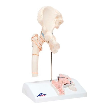 Fabrication Enterprises 3B Anatomical Model - Femoral Fracture and Hip Osteoarthritis 978091